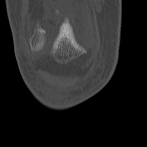 Chondrocalcinosis (Radiopaedia 16275-15955 Coronal bone window 11).jpg
