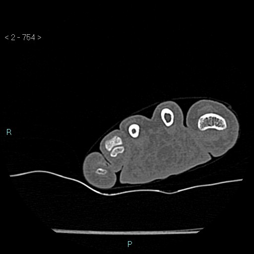Chondrosarcoma - phalanx (Radiopaedia 69047-78812 Axial bone window 8).jpg