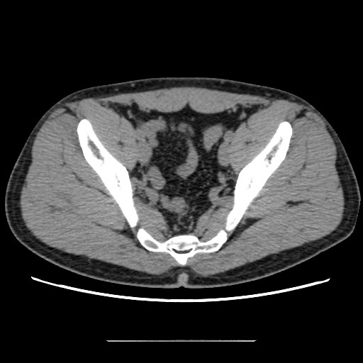 Chondrosarcoma of iliac wing (Radiopaedia 63861-72599 Axial non-contrast 77).jpg