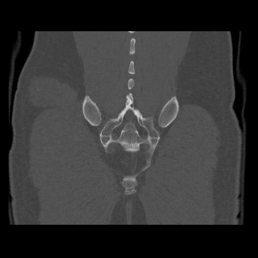 Chondrosarcoma of iliac wing (Radiopaedia 63861-72599 Coronal bone window 97).jpg