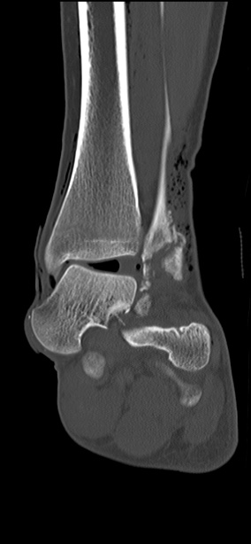 Chopart fracture (Radiopaedia 35347-36851 Coronal bone window 35).jpg