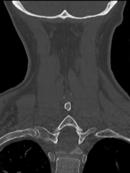 Chordoma (C4 vertebra) (Radiopaedia 47561-52188 Coronal bone window 48).png