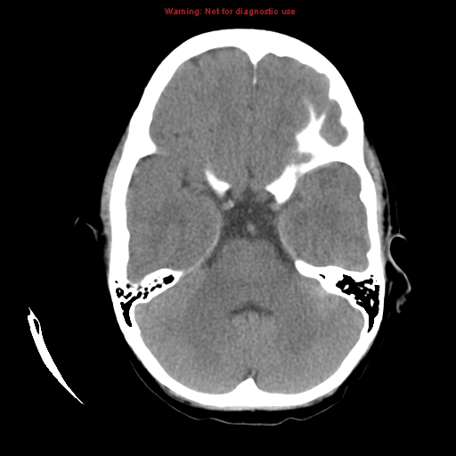 File:Choroid plexus carcinoma - recurrent (Radiopaedia 8330-9168 Axial non-contrast 7).jpg