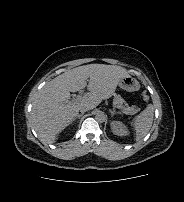 Chromophobe renal cell carcinoma (Radiopaedia 84337-99693 Axial non-contrast 31).jpg