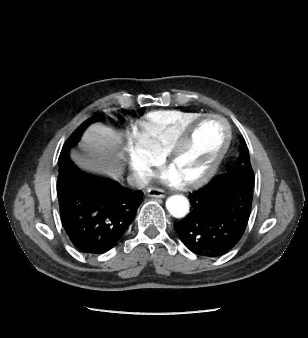 Chromophobe renal cell carcinoma (Radiopaedia 86879-103083 B 7).jpg