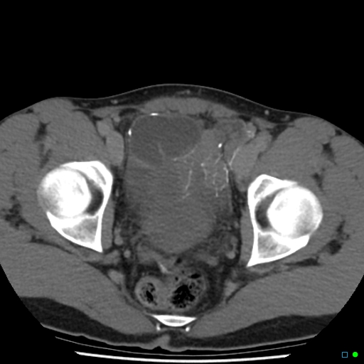 File:Chronic barium peritonitis and small bowel obstruction (Radiopaedia 29151-29548 D 15).jpg
