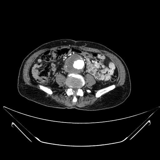 File:Chronic contained rupture of abdominal aortic aneurysm with extensive erosion of the vertebral bodies (Radiopaedia 55450-61901 A 40).jpg