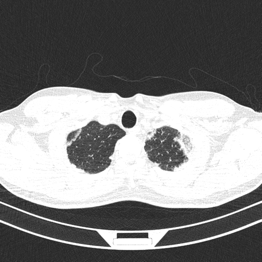 Chronic eosinophilic pneumonia (Radiopaedia 39331-41587 Axial lung window 6).png