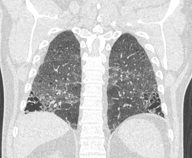 File:Chronic hypersensitivity pneumonitis (Radiopaedia 48107-52922 Coronal lung window 21).png