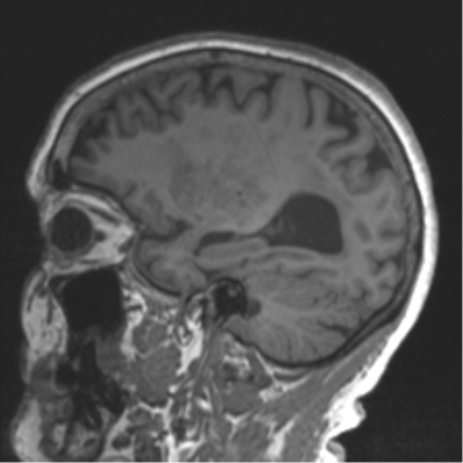 Chronic hypertensive encephalopathy (Radiopaedia 39993-42482 Sagittal T1 63).png