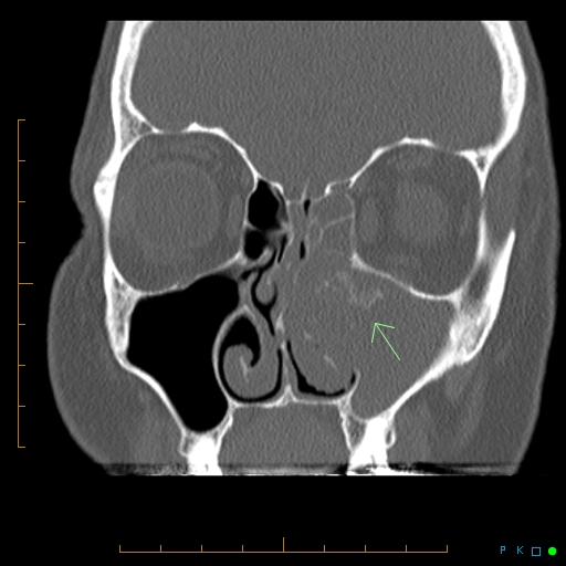 File:Chronic invasive fungal sinusitis with mycetoma (Radiopaedia 27430-27626 Coronal bone window 1).jpg