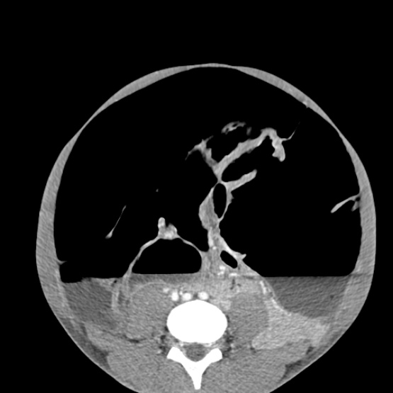 Chronic large bowel pseudo-obstruction (Radiopaedia 43181-46492 A 114).jpg