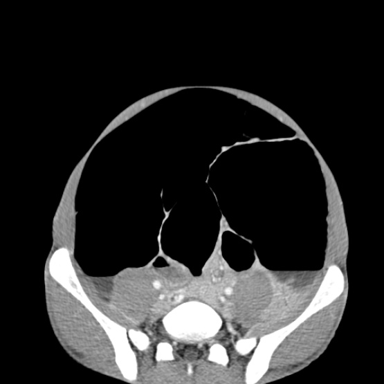 Chronic large bowel pseudo-obstruction (Radiopaedia 43181-46492 A 125).jpg
