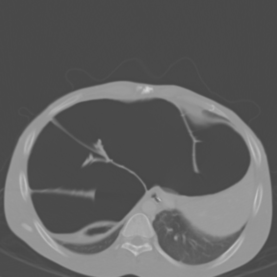 Chronic large bowel pseudo-obstruction (Radiopaedia 43181-46492 Axial bone window 36).jpg