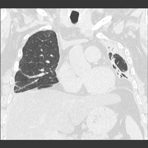 Chronic lung allograft dysfunction - restrictive form (Radiopaedia 60595-68316 Coronal lung window 47).jpg