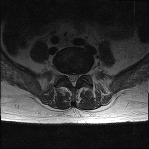 File:Chronic myeloid leukemia (MRI) (Radiopaedia 56128-62777 Axial T2 17).jpg
