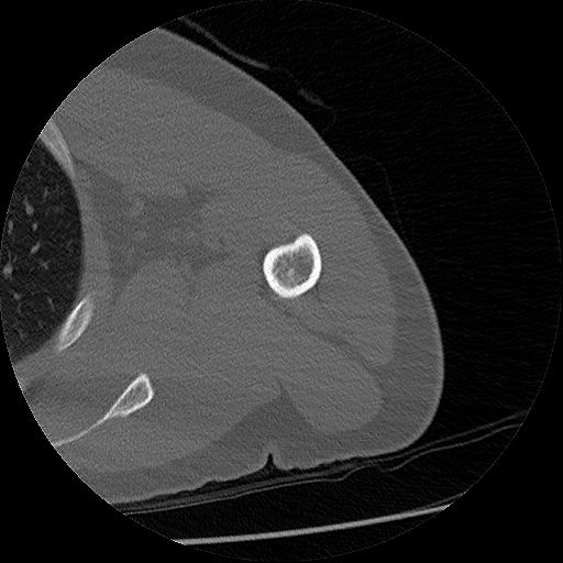 Chronic osteomyelitis (Radiopaedia 67597-76998 Axial bone window 15).jpg