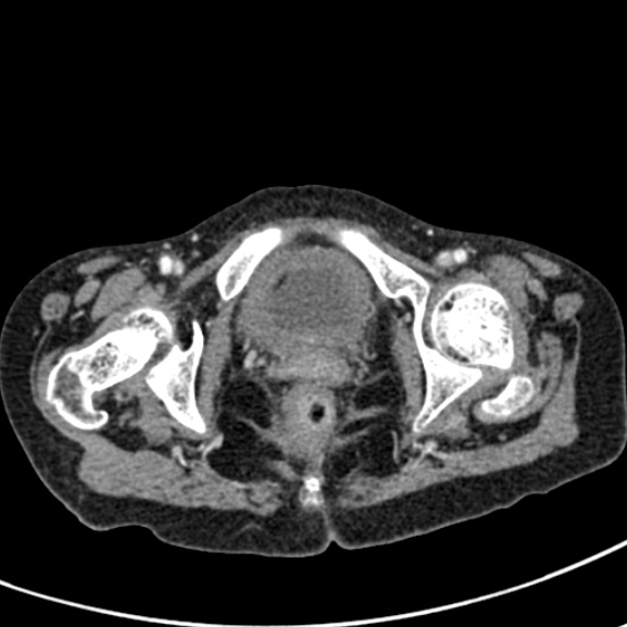 Chronic pancreatitis (Radiopaedia 55405-61846 A 105).jpg