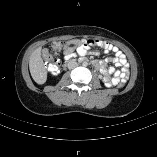 File:Chronic pancreatitis (Radiopaedia 64576-73450 C 86).jpg