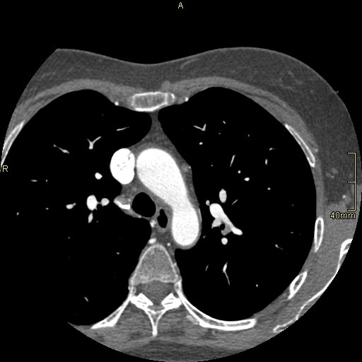 Chronic pulmonary embolism (Radiopaedia 73073-85094 Axial C+ CTPA 30).jpg