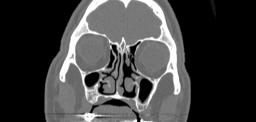 Chronic sphenoidal sinusitis (Radiopaedia 62030-70122 Coronal bone window 47).jpg
