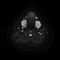 Chronic submandibular sialadenitis (Radiopaedia 61852-69885 Axial DWI 17).jpg