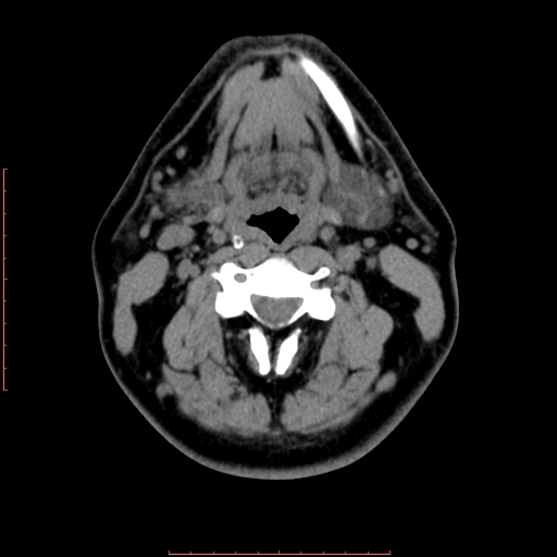 Chronic submandibular sialolithiasis (Radiopaedia 69817-79814 Axial non-contrast 118).jpg