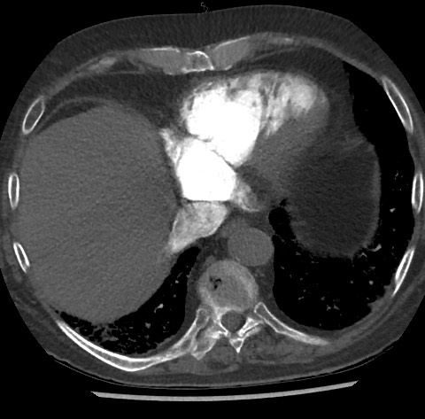 Chronic thromboembolic pulmonary disease (Radiopaedia 90694-108119 Axial C+ CTPA 76).jpg