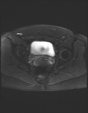 Class II Mullerian duct anomaly- unicornuate uterus with rudimentary horn and non-communicating cavity (Radiopaedia 39441-41755 Axial DWI 19).jpg