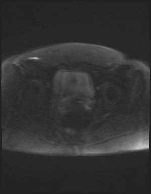 Class II Mullerian duct anomaly- unicornuate uterus with rudimentary horn and non-communicating cavity (Radiopaedia 39441-41755 Axial DWI 83).jpg