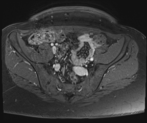File:Class II Mullerian duct anomaly- unicornuate uterus with rudimentary horn and non-communicating cavity (Radiopaedia 39441-41755 Axial T1 fat sat 24).jpg