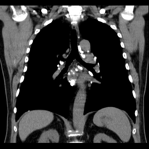 File:Classic complicated silicosis (Radiopaedia 49720-54961 Coronal liver window 36).jpg