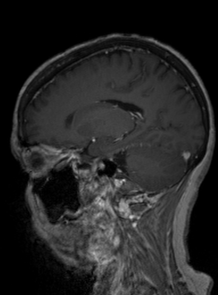 Clival meningioma (Radiopaedia 53278-59248 Sagittal T1 C+ 292).jpg