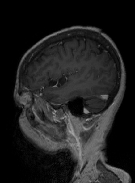 Clival meningioma (Radiopaedia 53278-59248 Sagittal T1 C+ 339).jpg