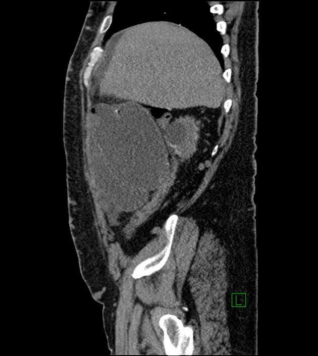Closed-loop small bowel obstruction-internal hernia (Radiopaedia 78439-91096 C 114).jpg