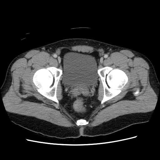 Closed-loop small bowel obstruction (Radiopaedia 73713-84509 A 161).jpg