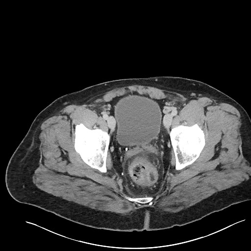 File:Closed loop obstruction - internal hernia into nephrectomy bed (Radiopaedia 59867-67320 Axial 120).jpg