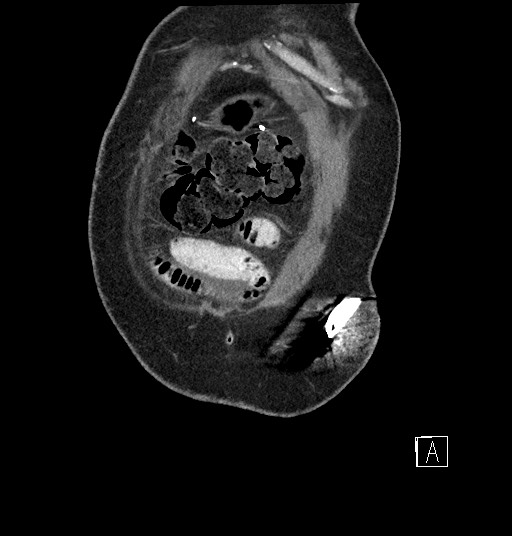 Closed loop obstruction - internal hernia into nephrectomy bed (Radiopaedia 59867-67320 B 1).jpg