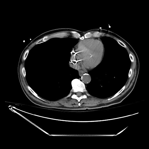 Closed loop obstruction due to adhesive band, resulting in small bowel ischemia and resection (Radiopaedia 83835-99023 Axial non-contrast 13).jpg