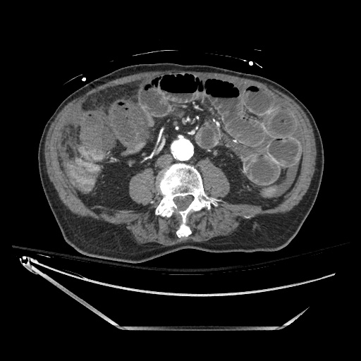 File:Closed loop obstruction due to adhesive band, resulting in small bowel ischemia and resection (Radiopaedia 83835-99023 B 86).jpg
