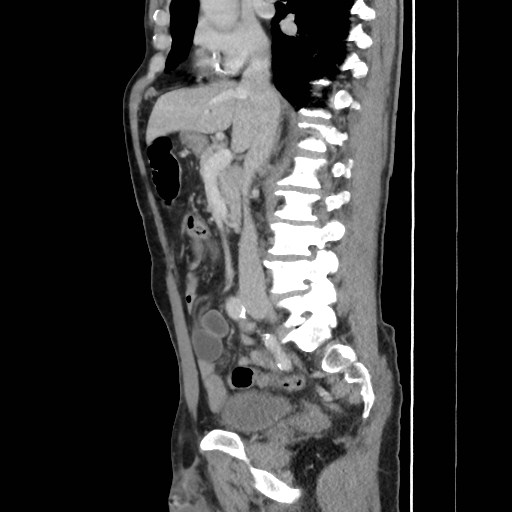 File:Closed loop small bowel obstruction (Radiopaedia 59227-66554 C 29).jpg