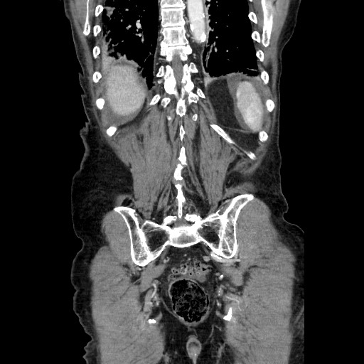 File:Closed loop small bowel obstruction - adhesive disease and hemorrhagic ischemia (Radiopaedia 86831-102990 B 105).jpg