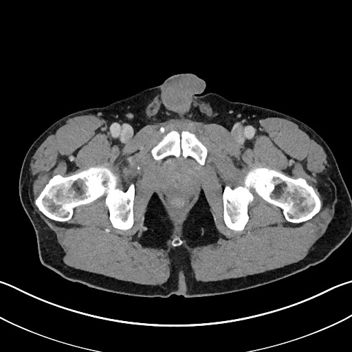 Closed loop small bowel obstruction - internal hernia (Radiopaedia 57806-64778 B 129).jpg