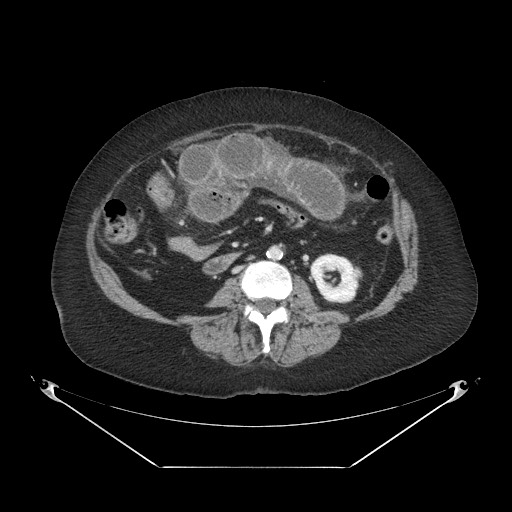 Closed loop small bowel obstruction - internal hernia (Radiopaedia 65402-74450 A 67).jpg