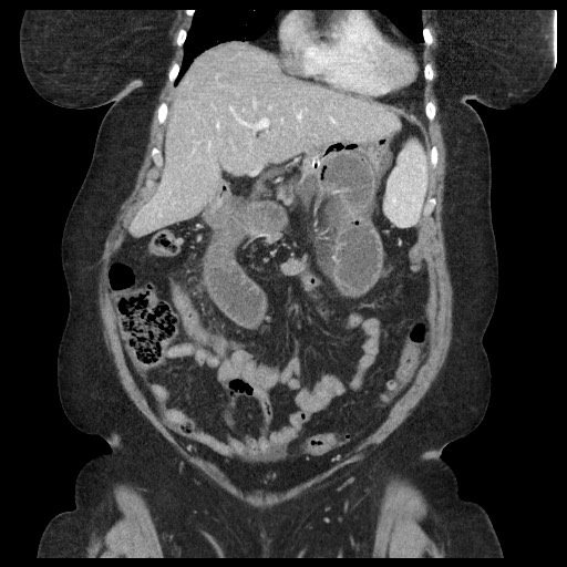 Closed loop small bowel obstruction - internal hernia (Radiopaedia 65402-74450 B 38).jpg