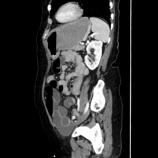 Closed loop small bowel obstruction due to adhesive band, with intramural hemorrhage and ischemia (Radiopaedia 83831-99017 D 135).jpg