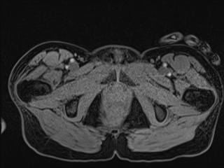 Closed loop small bowel obstruction in pregnancy (MRI) (Radiopaedia 87637-104031 G 31).jpg