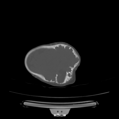 Cloverleaf skull (Radiopaedia 91901-109710 Axial bone window 128).jpg