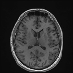 Cochlear incomplete partition type III associated with hypothalamic hamartoma (Radiopaedia 88756-105498 Axial T1 114).jpg