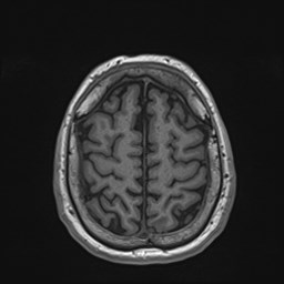 Cochlear incomplete partition type III associated with hypothalamic hamartoma (Radiopaedia 88756-105498 Axial T1 159).jpg